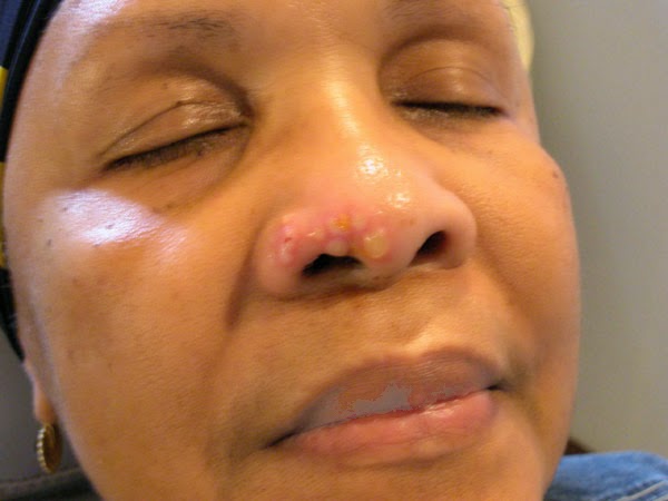 La medicina contra el hongo con levadura en la oreja